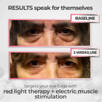 Lumera® 2-in-1 Red Light Therapy + EMS To Erase Eye Bags