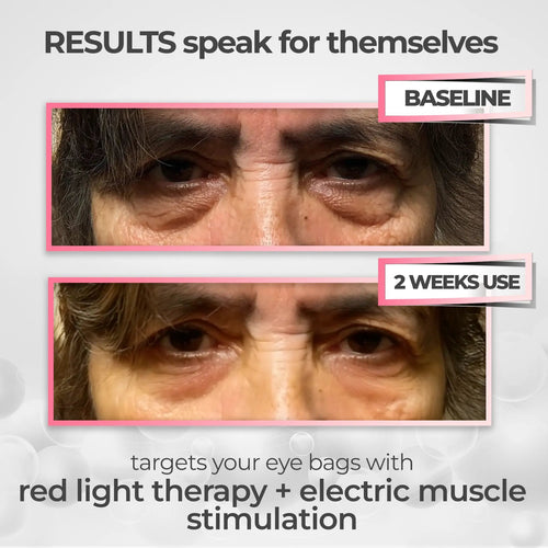 Lumera® 2-in-1 Red Light Therapy + EMS To Erase Eye Bags